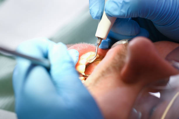 Best Emergency Dentist for Knocked-Out Tooth in Carmi, IL